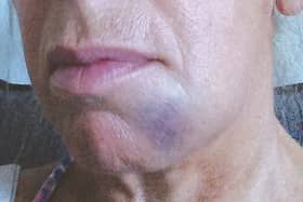 The severe bruising Lorraine suffered as a result of her treatment.