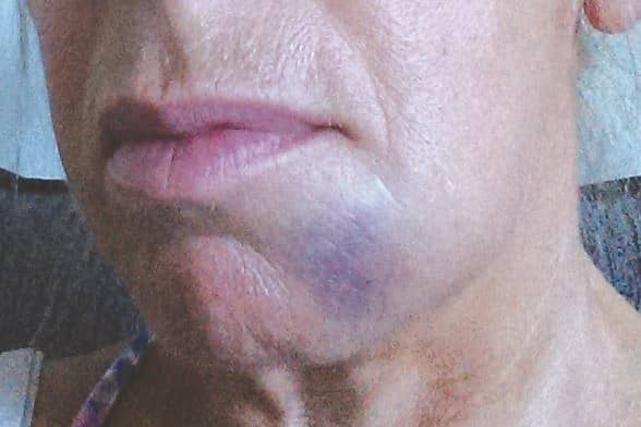 The severe bruising Lorraine suffered as a result of her treatment.