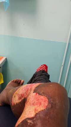 A picture of the infected leg taken by the patient himself