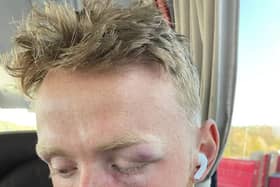 Viktor Johansson's damaged eye